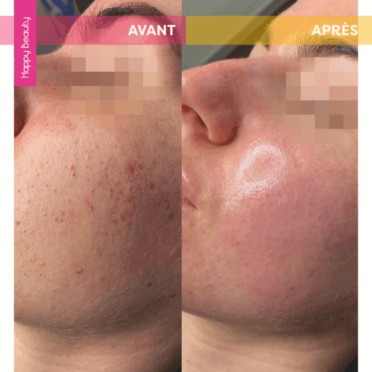 Avant après soin visage happy beauty