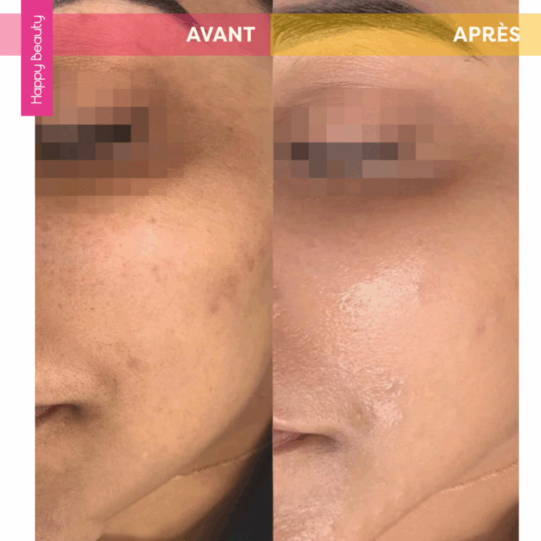 Avant et après soins visage HB