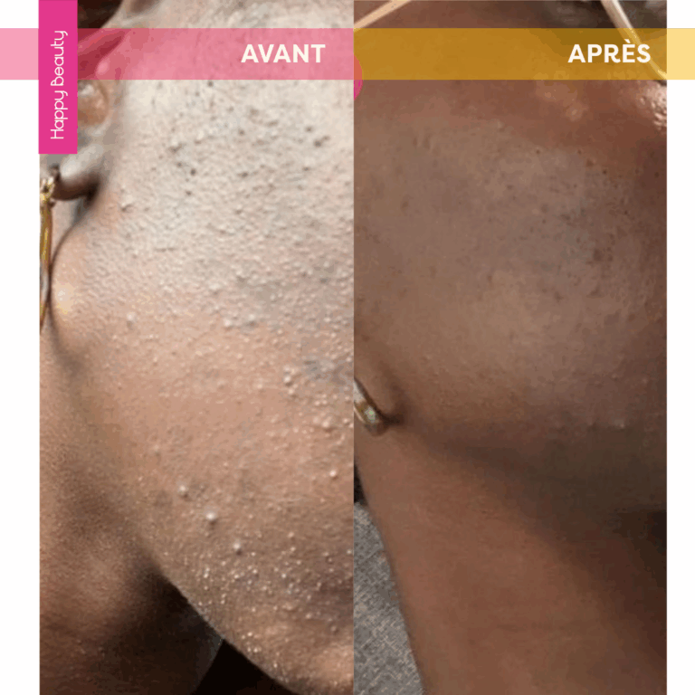 Incroyable avant après soins happy beauty